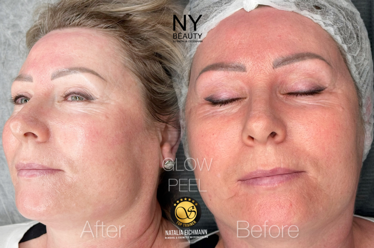 Gesichtsreinigung in Quierschied in Saarland