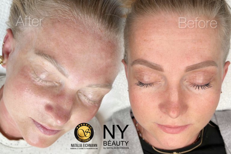Microneedling Behandlung 