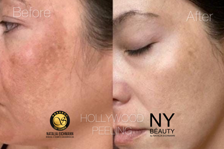 Carbon Peeling Hollywood Peeling in Saarbrücken