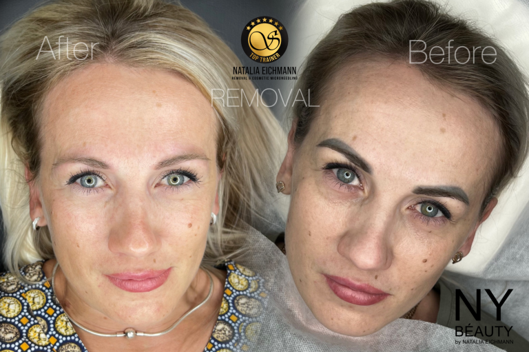 Entfernung Tattoo Removal